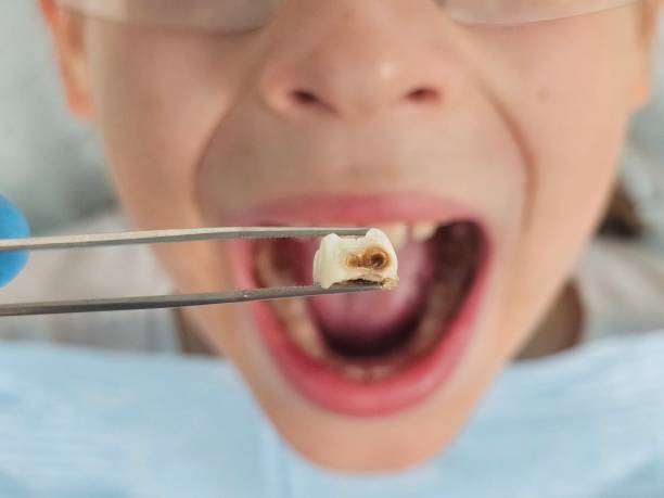 Best Dentist for Tooth Abscess  in Forrest City, AR